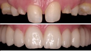 металлокерамика полтава