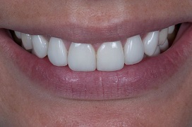 металлокерамические коронки цена полтава